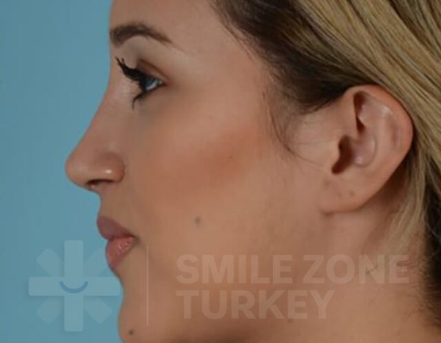 Rhinoplasty-after-2