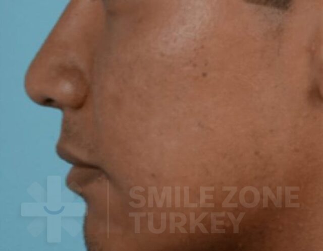 Rhinoplasty-after-3