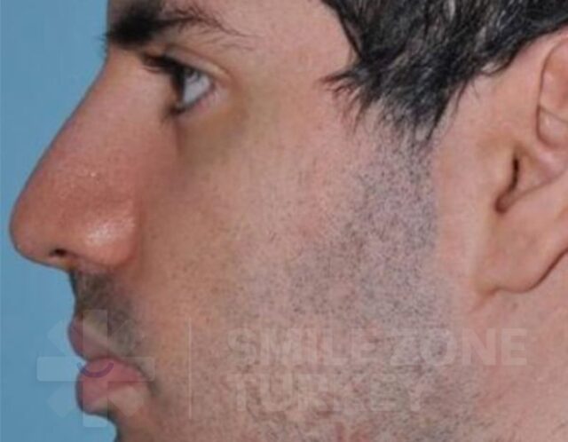 Rhinoplasty-after-4