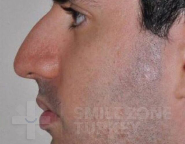 Rhinoplasty-before-4