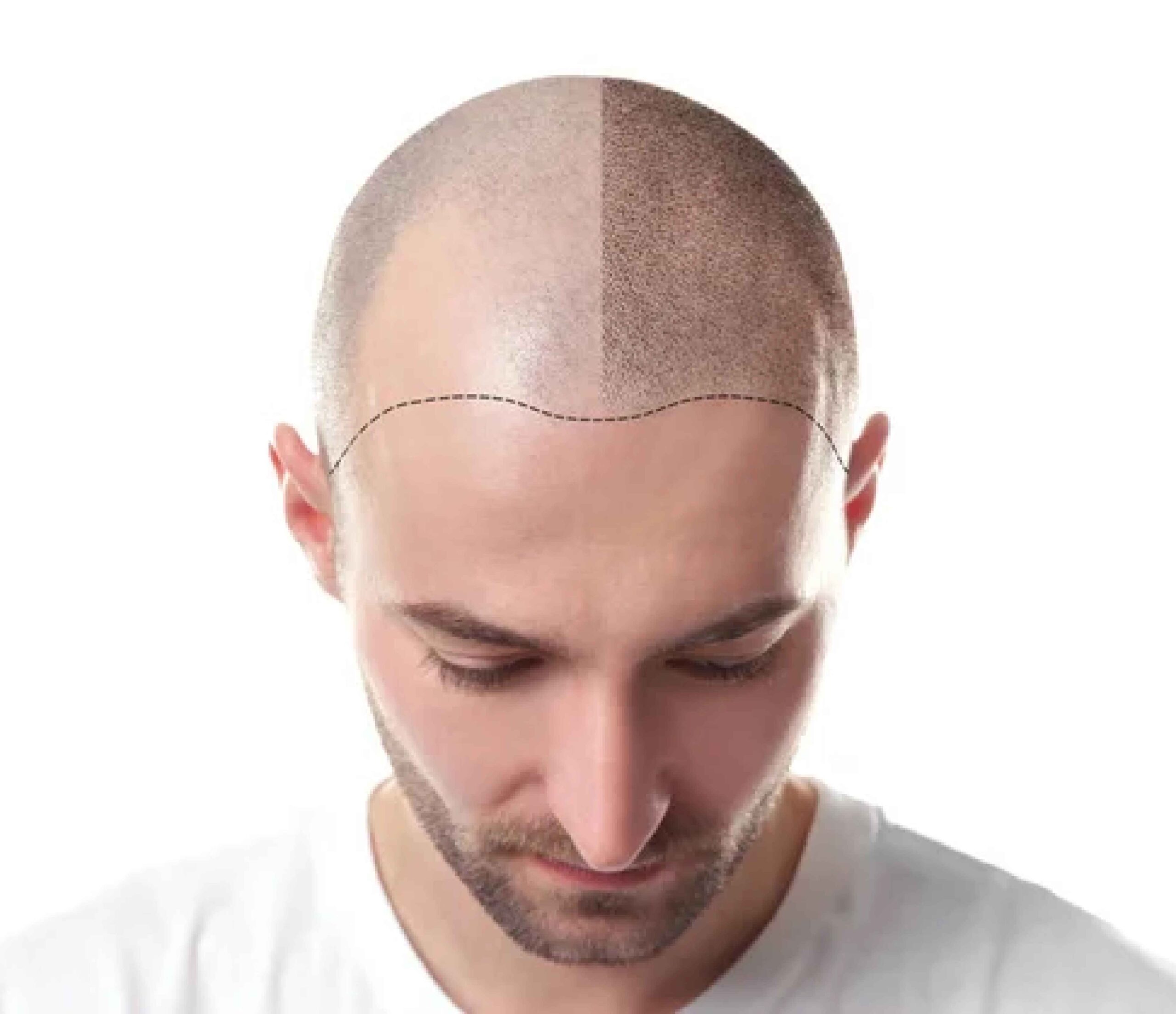 hair transplant